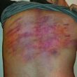 Marks of Armin Davoodi's interrogation by authorities in Iran. (Morning Star News)