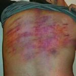 Marks of Armin Davoodi's interrogation by authorities in Iran. (Morning Star News)