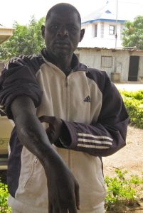 Scars on Adamu Musa, shot by Boko Harm in attack on I Gava West village, Gwoza, Borno state in 2013. (Morning Star News)