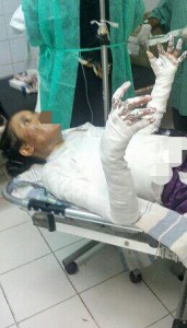 Nazeera receiving hospital treatment after fire attack. (Morning Star News via Saeed)