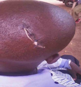 Wound sustained by John Supete after attack in eastern Uganda. (Morning Star News)