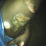 Burns on Gobera Bashir’s leg from attack my Muslim relatives. (Morning Star News)