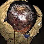 Wounded head of Christian worshipper in Paw Lwe village, central Burma on Dec. 17, 2018. (Morning Star News)