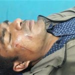 Pastor Dhurba Kumar Pariyar after motorcyclists attacked him in Sarlahi District, Nepal. (Morning Star News)