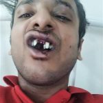 Abhishek Mangala lost teeth in assault by Hindu extremists in Sohna, Haryana state, India on Sept. 22, 2019. (Morning Star News)