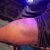 Bruising on pastor Pastor Indresh Kumar Gautam in Kunda area, Uttar Pradesh state, India. (Morning Star News)