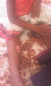 Some of the burns on Rehema Kyomuhendo, recovering in hospital in Mbale, Uganda. (Morning Star News)