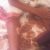 Some of the burns on Rehema Kyomuhendo, recovering in hospital in Mbale, Uganda. (Morning Star News)