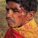Madvi Muka sustained serious head wounds in attack in Sukma District, Chhattisgarh state, India. (Morning Star News)