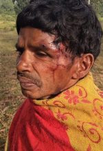 Madvi Muka sustained serious head wounds in attack in Sukma District, Chhattisgarh state, India. (Morning Star News)