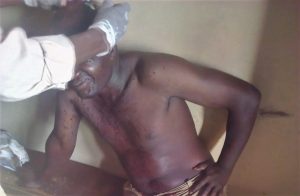 Abudlawali Kijwalo receives medical treatment after machete attack in Kibuku District, Uganda on June 27, 2021. (Morning Star News)