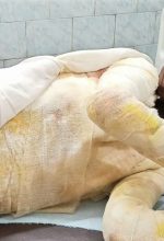 Attack in Bihar state, India left Nitish Kumar, 14, with burns on 65 percent of his body. (Morning Star News)