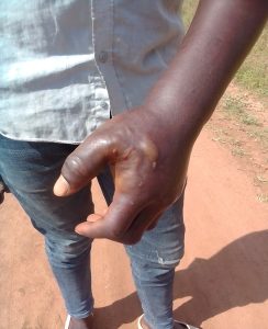 Hand injuries Robert Faisali Miya sustained in Aug. 11, 2023 assault in Busolwe, Uganda. (Morning Star News)