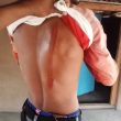 Scar on one of the Christians assaulted in Durandarbha village, Sukma District, Chhattisgarh state, India on April 24, 2025. (Evangelical Fellowship of India)