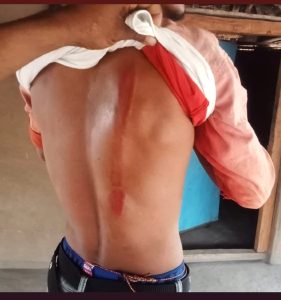 Scar on one of the Christians assaulted in Durandarbha village, Sukma District, Chhattisgarh state, India on April 24, 2025. (Evangelical Fellowship of India)
