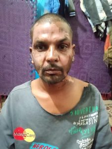 Zahid Morris a été grièvement brûlé au visage et au cou après avoir été aspergé d'essence et brûlé vif par un musulman le 21 janvier 2026. (Christian Daily International-Morning Star News)